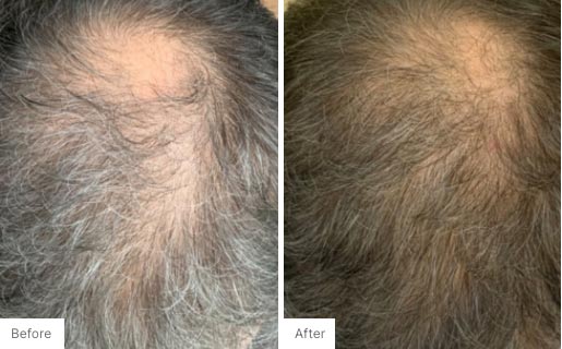 1 - Before and After Real Results picture of a man's scalp.