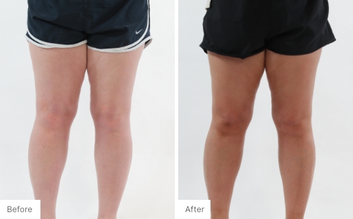 2 - Before and After Real Results of a woman's legs from using the 3-in-1 Self Tanning + Sculpting Foam.